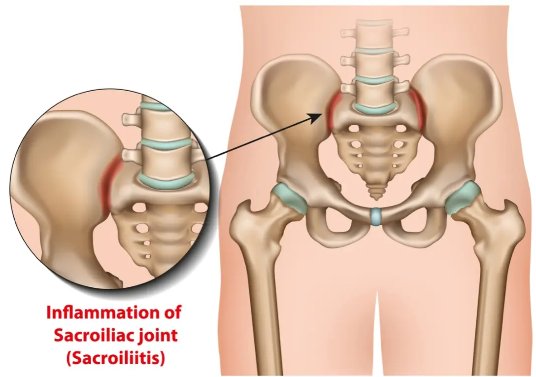 Healing Sacroiliac Joint Pain Naturally